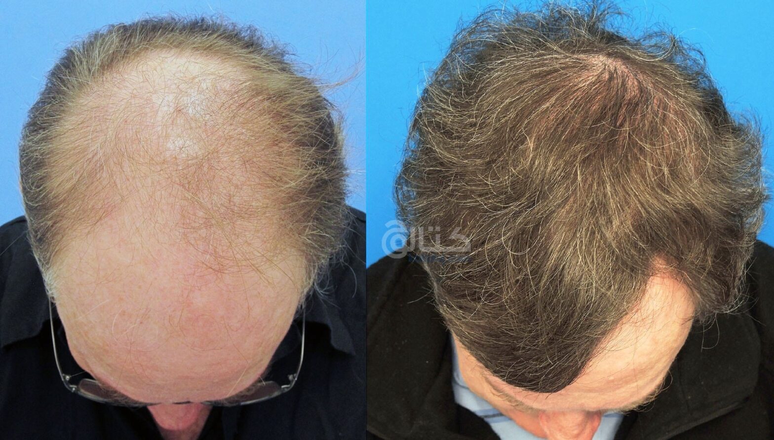 تكلفة زراعة الشعر في مصر - دكتور محمد